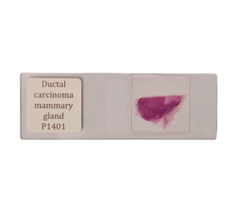 Mammary gland w. ductal carcinoma